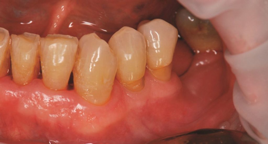 34-et-35-atteintes-d-abfraction-chez-un-patient-de-76-ans