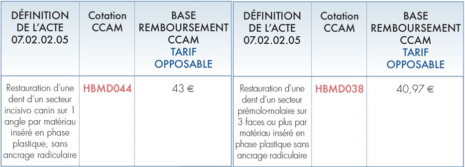 Restauration-d-une-dent-premolo-molaire