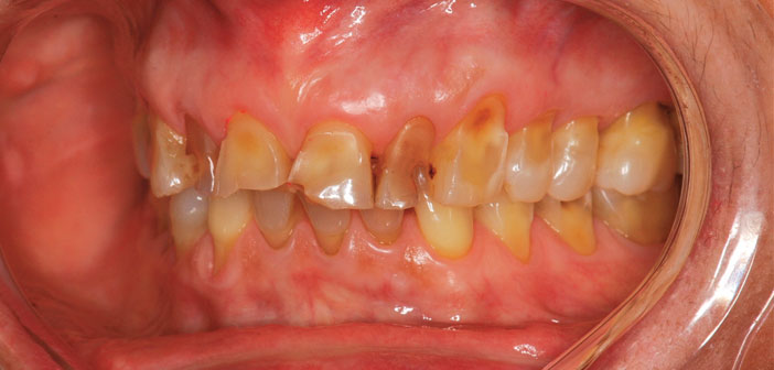 Usures-dentaires-les-etiologies