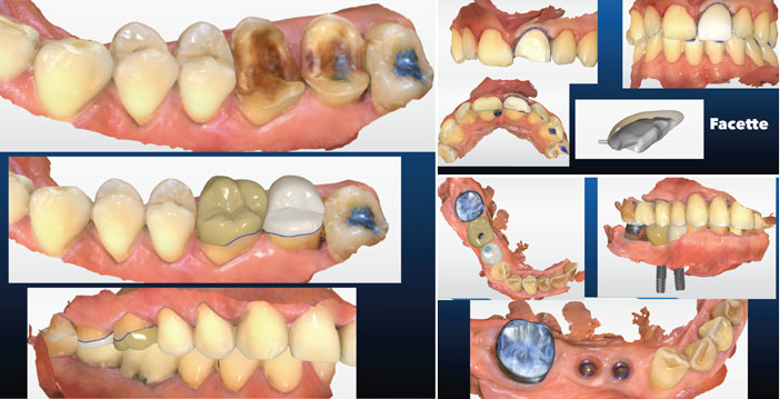 couronnes-transvissees-sur-implants-en-Emax