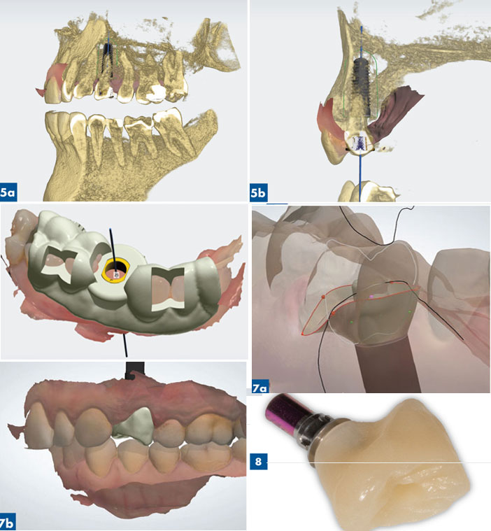 guide chirurgical