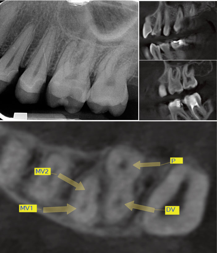 lesion-racine-palatine