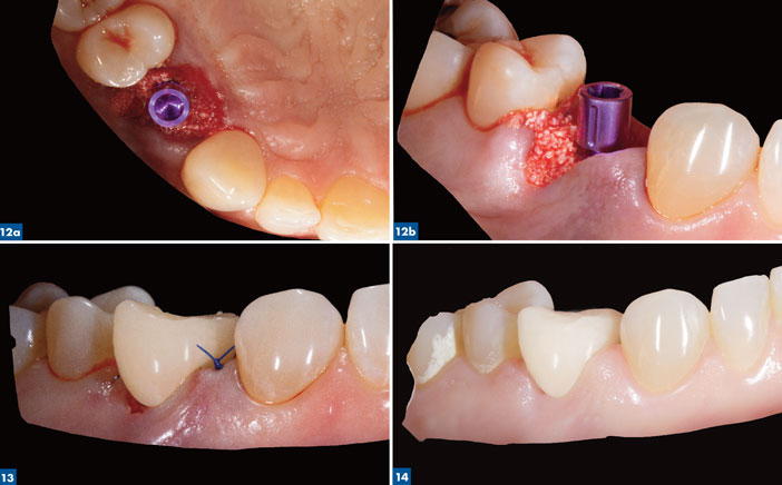 mise-en-place-d-un-implant-CAMLOG