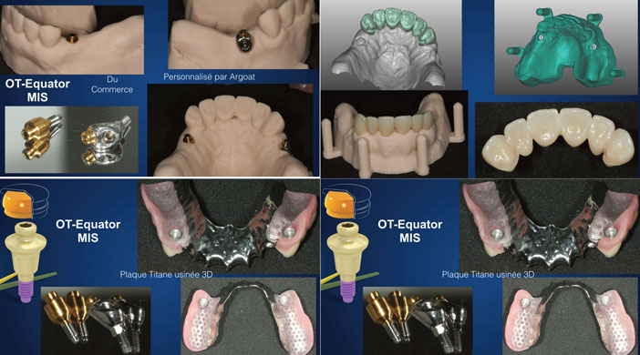 modelisation-sous-Exocad