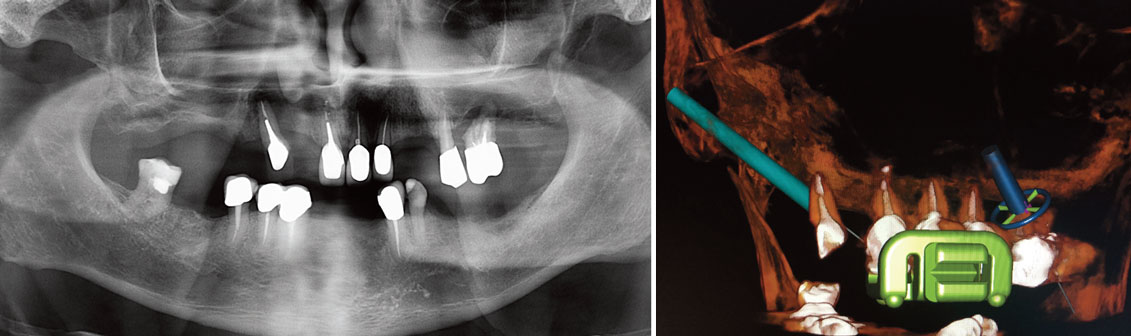 radiographie-panoramique-pre-operatoire