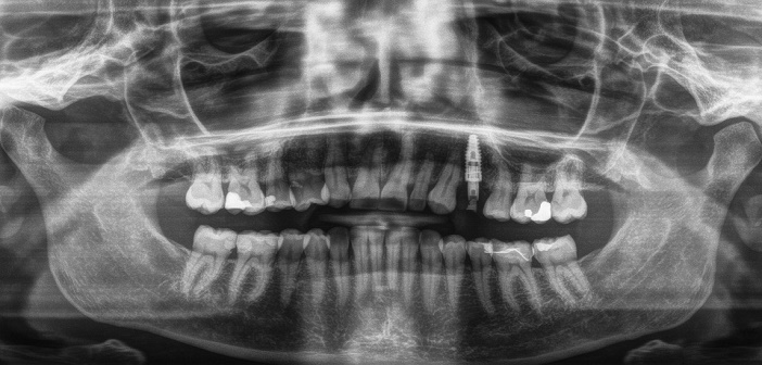 radiographie post-operatoire