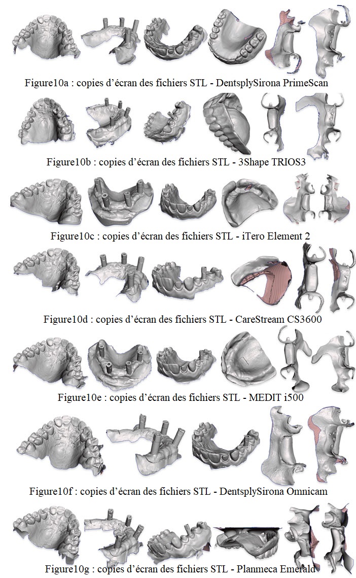 scan-de-la-prothese-complete