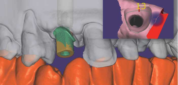 Eclaircissement-et-stratification-anterieure-au-composite