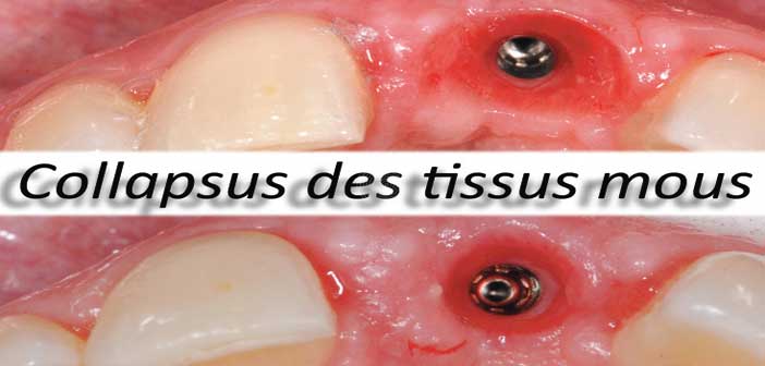 collapsus-des-tissus