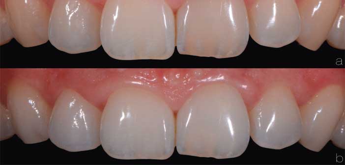 eclaircissement-externe