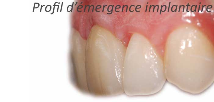emergence-implantaire