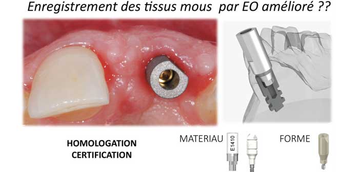 empreinte-optique-intra-orale