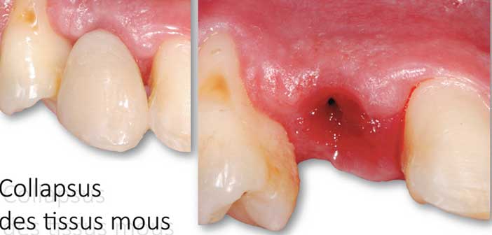 illustration-du-collapsus-des-tissus