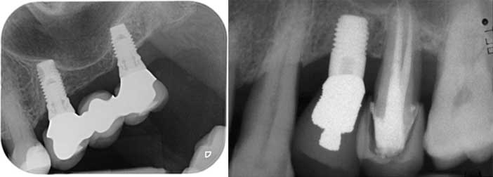 implantes-deux