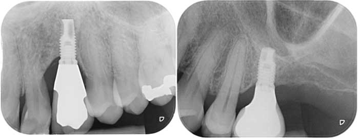 implantes-quatre