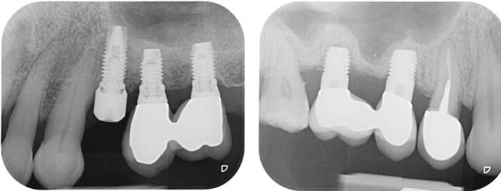 implantes-trois