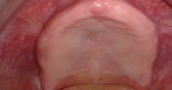 Gestion du réflexe nauséeux en prothèse amovible complète : A propos de deux cas cliniques