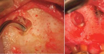 La place du microscope opératoire en endodontie chirurgicale figure-neuf