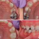 Pediatric crown