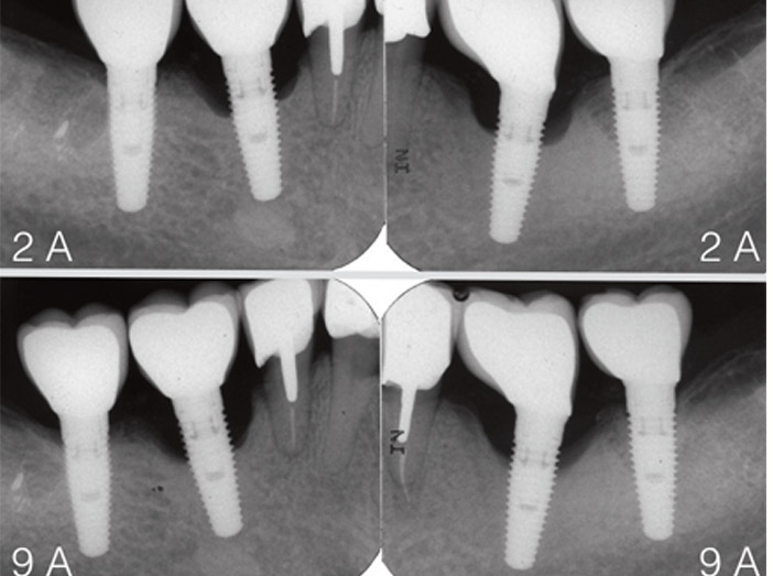 Traitement d'une péri-implantite et son suivi : est-ce réellement aussi  simple ? – L'Information Dentaire