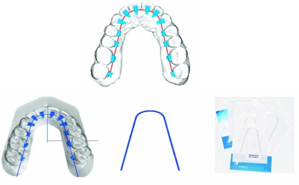 Quid de l’orthodontie linguale en 2021