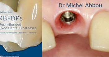 BRIDGE COLLE MONO-AILETTE versus IMPLANT UNITAIRE en zone esthétique