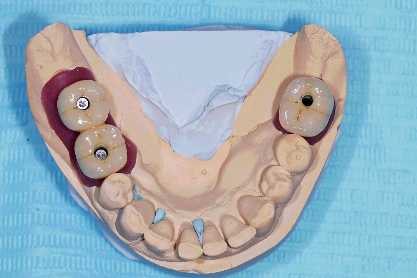 Obturation dentaire : matériaux, étapes du traitement, ce qu'il vous faut  savoir