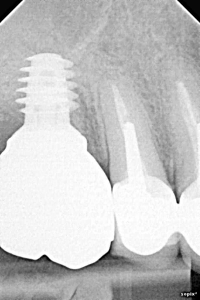 LES IMPLANTS COURTS AU MAXILLAIRE POSTERIEUR UNE ALTERNATIVE STRATÉGIQUE FIABLE ET PEU
