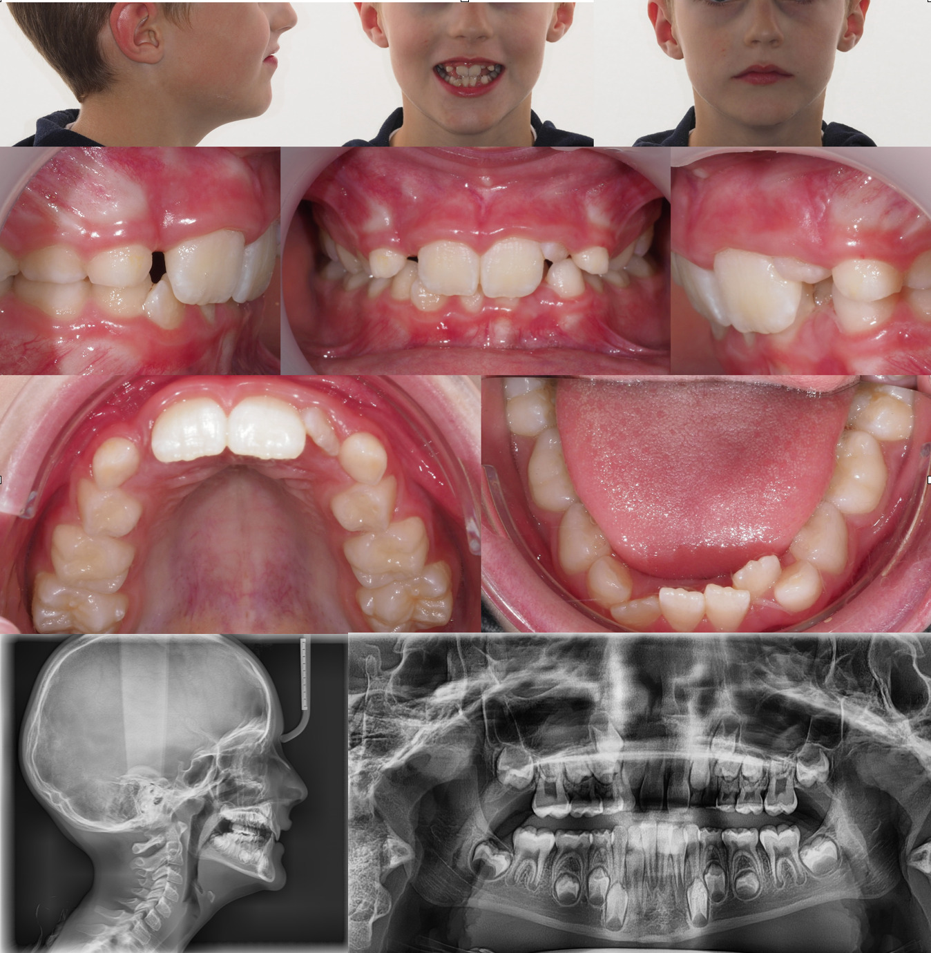 Pack de 3 Gouttières d'alignement dentaire - La Boutique de la Santé