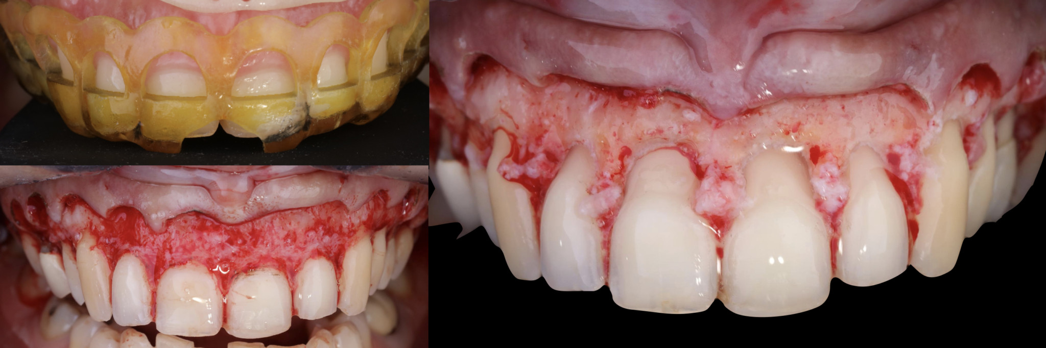 CORRECTION DU SOURIRE GINGIVAL ET APPORT DE LA PROTHÈSE SOUSNASALE LE BIOVOLUME