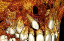 Mini-vis : l'orthodontie de demain