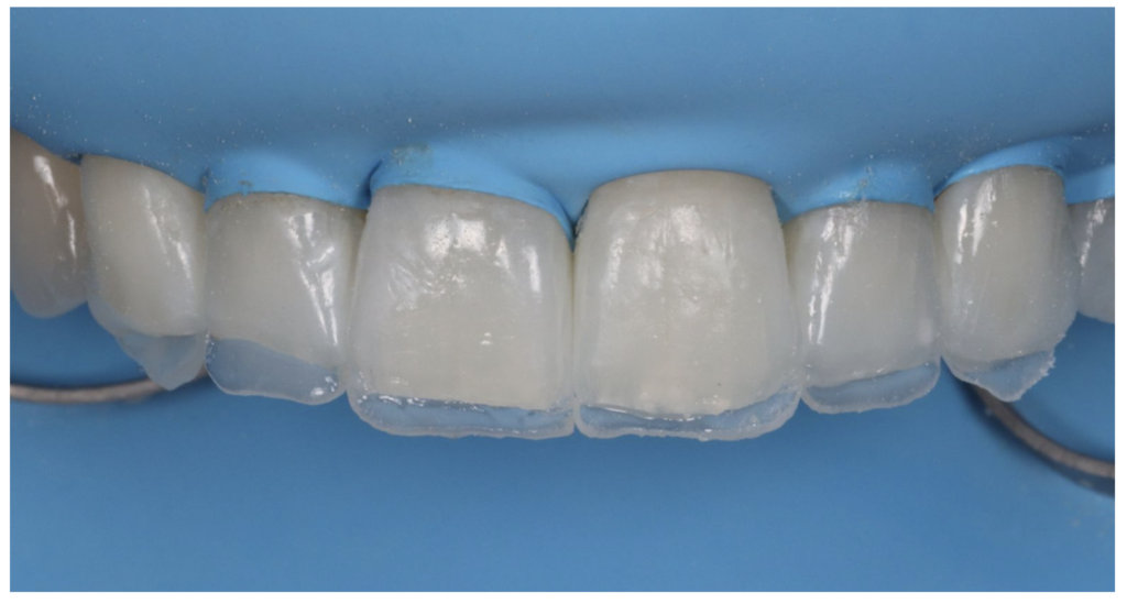 2 Matrices Cervicales Transparentes Dentaires – Pour Restaurations Composites Et Rétraction Gingivale
