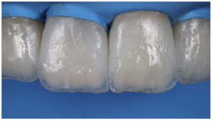 Jeu De Moules Pour Facettes Dentaires En Composite - Pour Formation Ou Blanchiment Antérieur Rapide