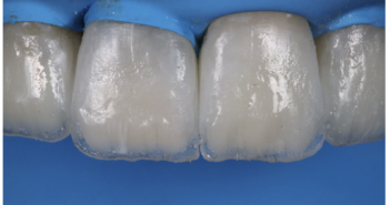 STRATIFICATION DES COMPOSITES EN ANTÉRIEUR : SIMPLIFICATION ET NOUVEAUX CONCEPTS