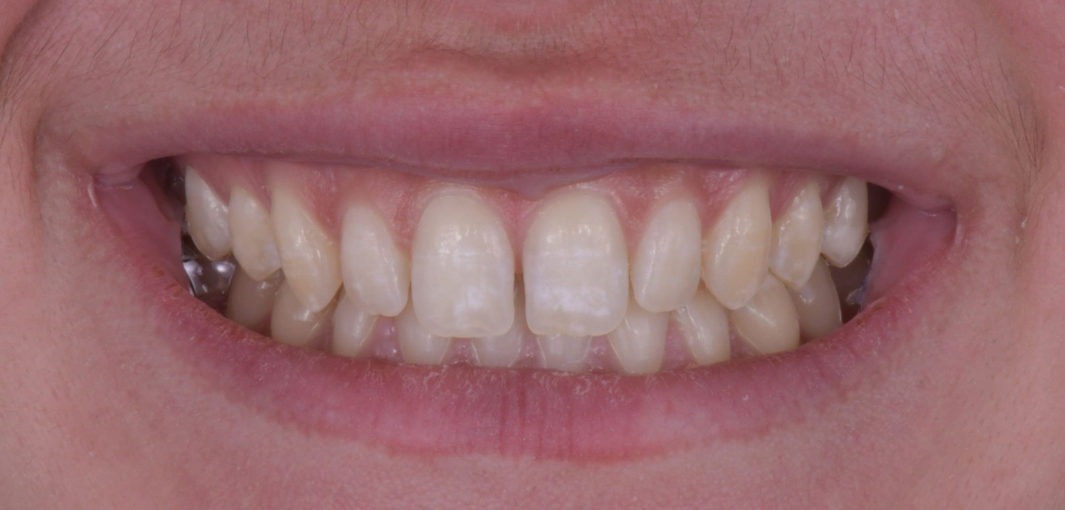 Cales Dentaires Jetables Avec Trou - 4 Tailles (XS, S, M, L) - Pour Diastème - Marque AZDENT