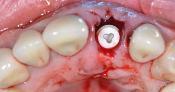 LE CONCEPT IMPLANTAIRE PEUT-IL PRÉVENIR LA PÉRIIMPLANTITE ? : APPORT DE L’IMPLANT PATENT TM
