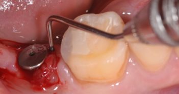 LA PÉRIIMPLANTITE : SUJET PHARE EN IMPLANTOLOGIE POUR LES 20 PROCHAINES ANNÉES