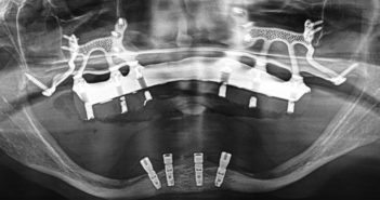 LES IMPLANTS SOUS-PÉRIOSTÉS DANS LE TRAITEMENT DE L’ÉDENTÉ COMPLET MAXILLAIRE