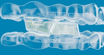 INVISALIGN® AVEC AVANCÉE MANDIBULAIRE ET BLOCS OCCLUSAUX : NOUVELLE OPTION POUR LES CLASSES II EN CROISSANCE